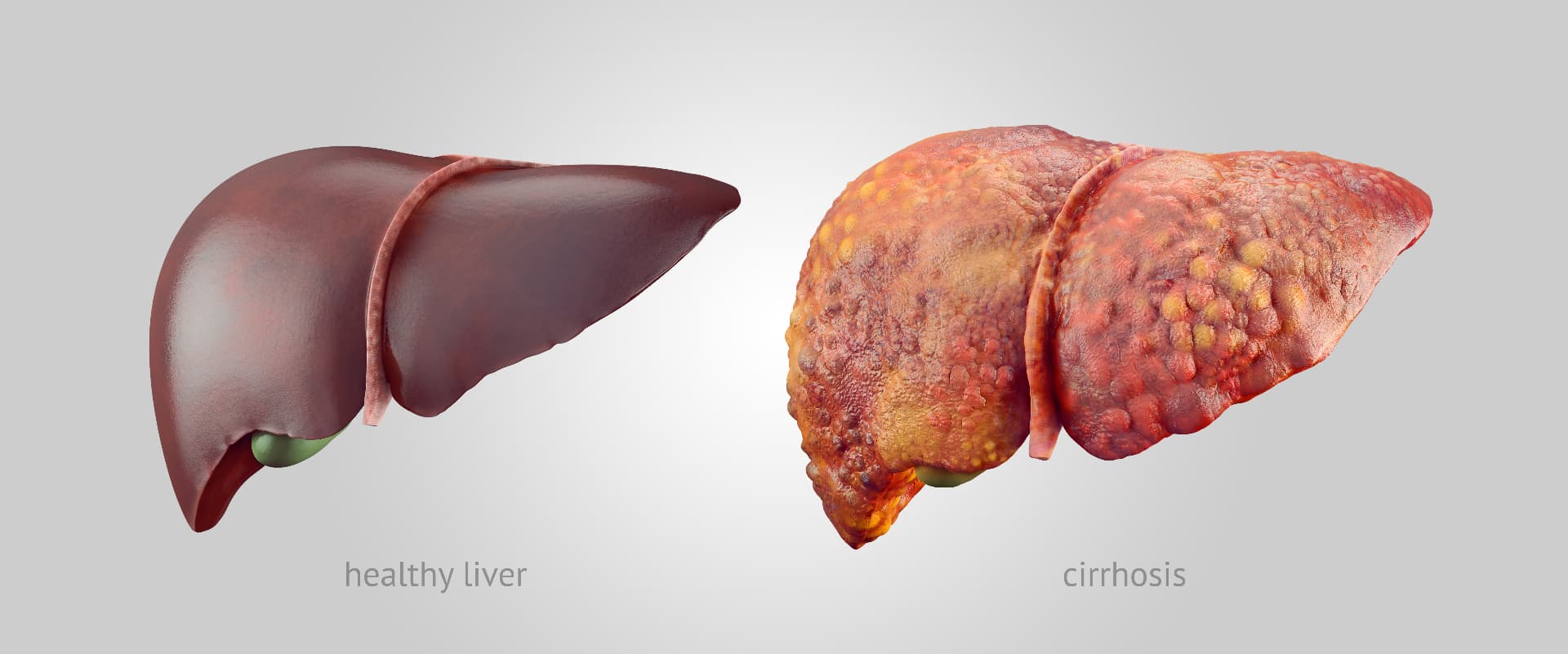 Comparison of healthy liver versus liver with cirrhosis showing scarring and damage