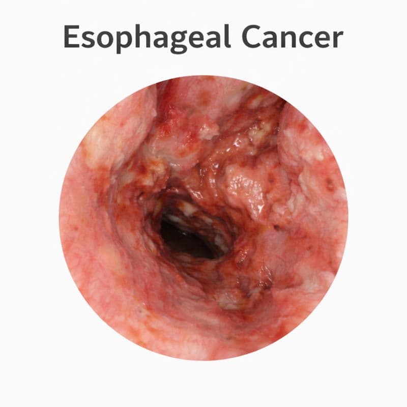 Oesophageal Cancer