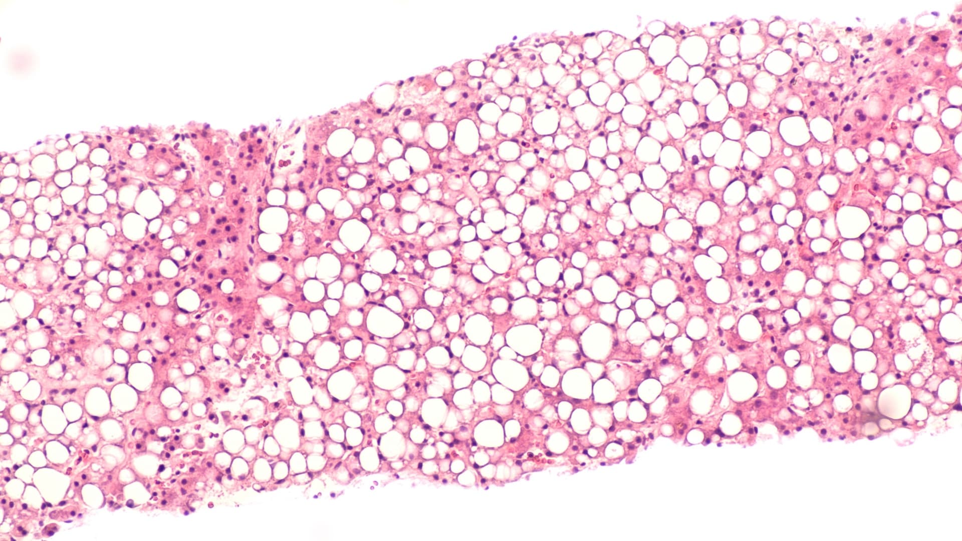 Histological slide showing fatty liver tissue with lipid droplets