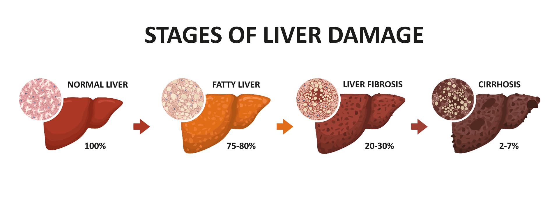 Stages of liver damage progression from normal liver to cirrhosis