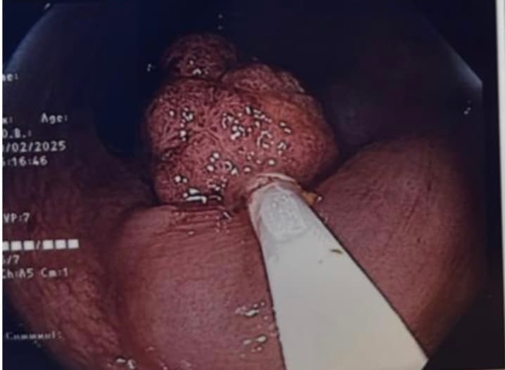 Polypectomy procedure during colonoscopy