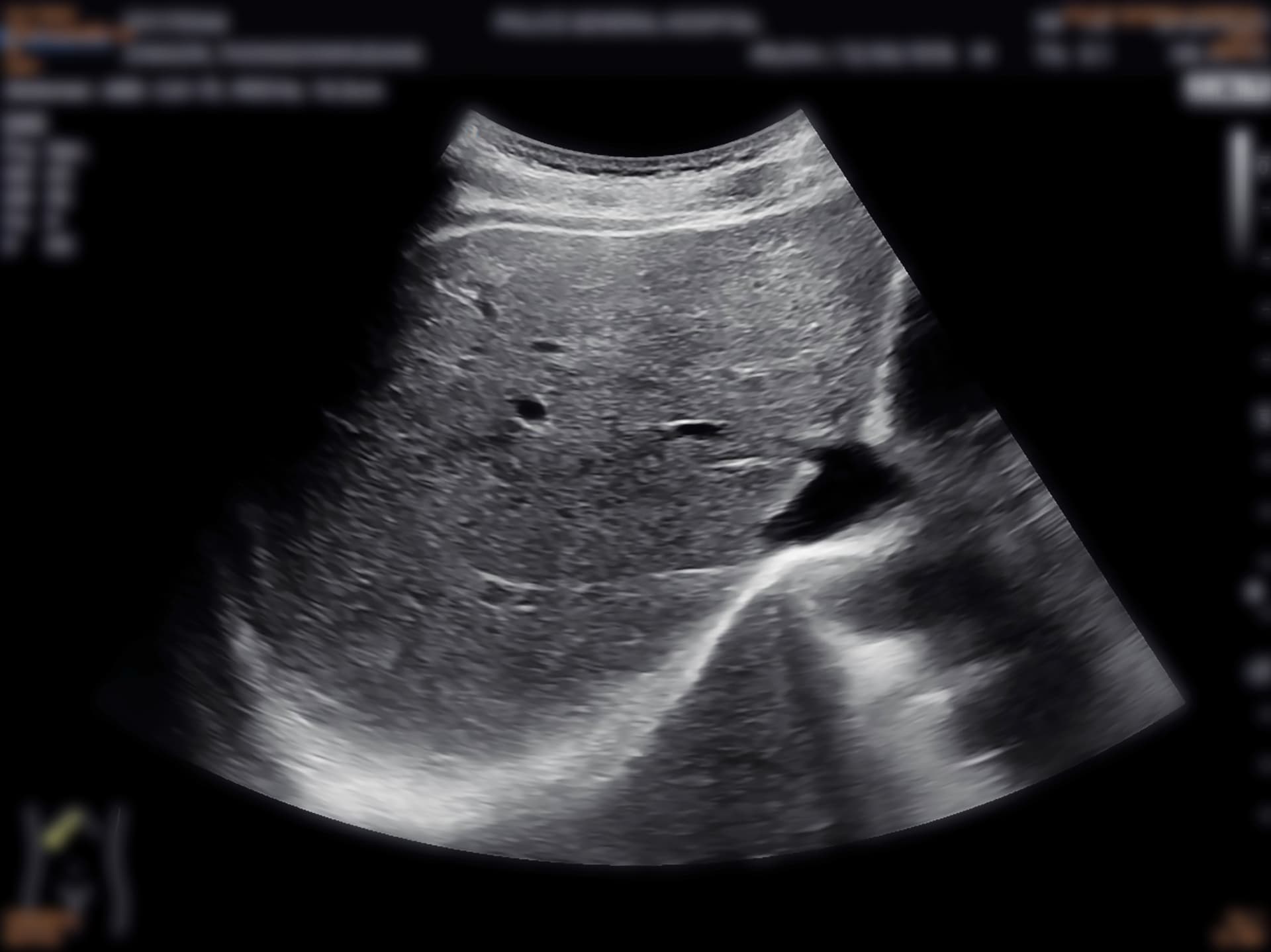 Ultrasound examination of the liver