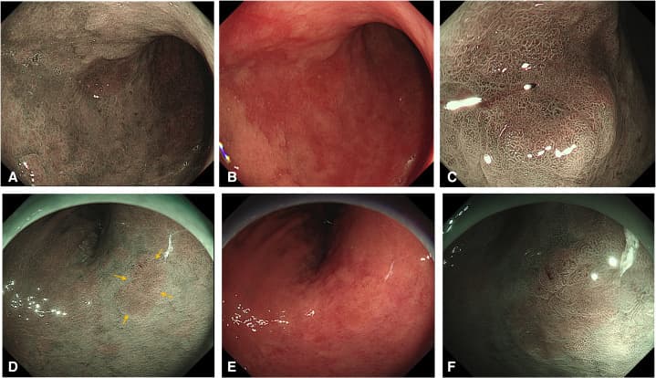 Clinical endoscopic images, panels A to F, illustrating narrow band imaging of gastric lesions